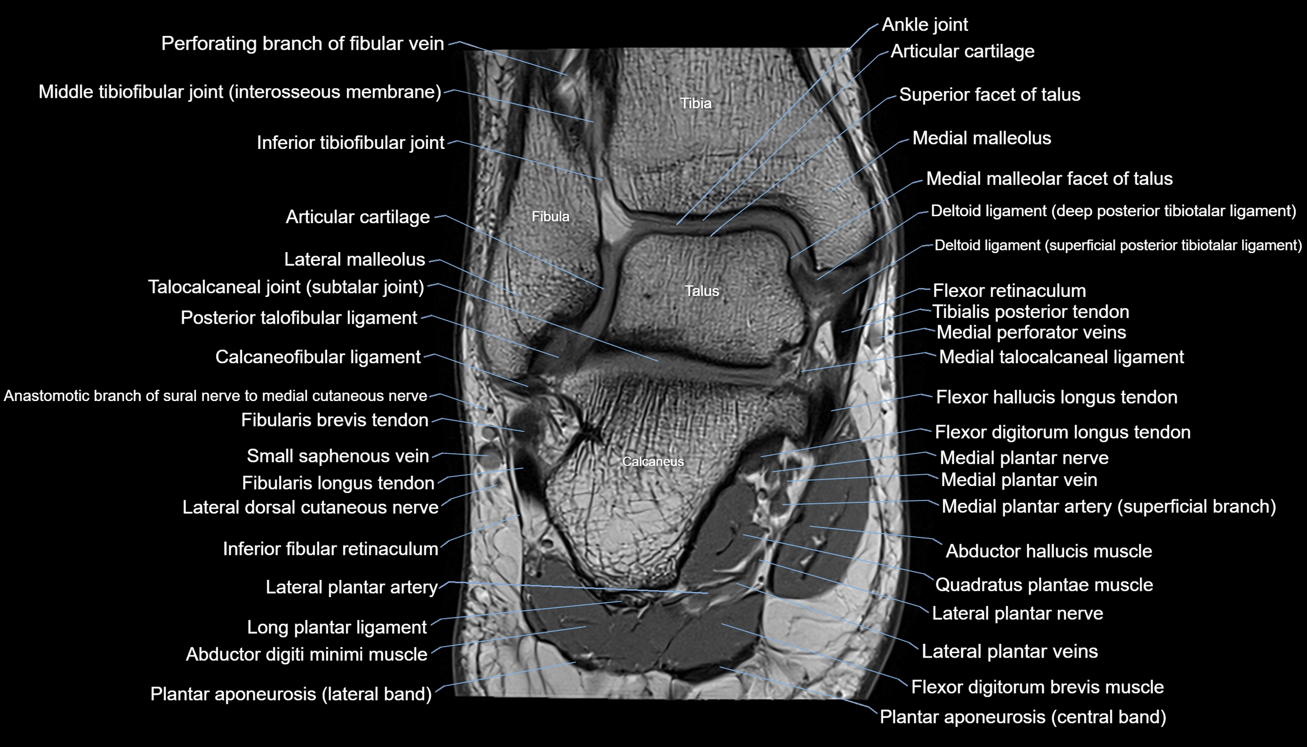 Ankle coronal anatomy 3T MRI images -img-11001-00014.webp